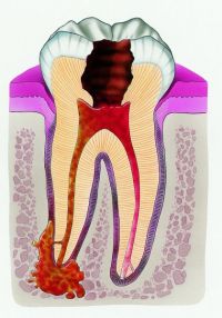 periodontit-200x286.jpg